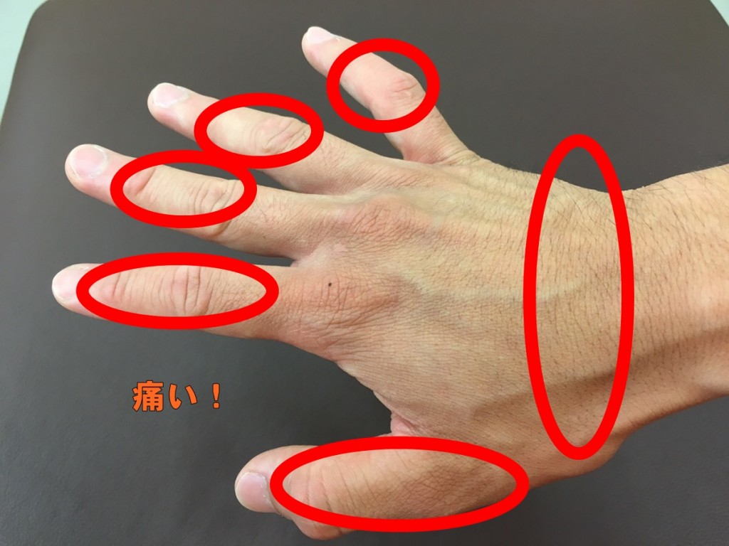 箕面市牧落で人気のみゅう整骨院腱鞘炎の症状は3段階ある!腱鞘炎は性別も関係します!