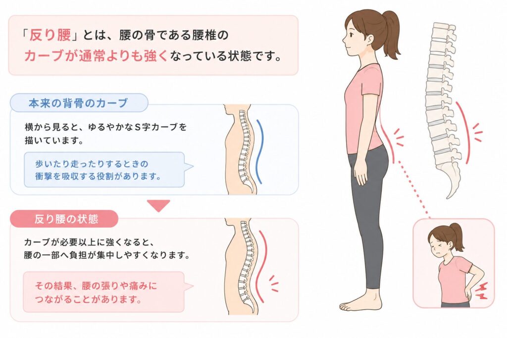 反り腰とは何かを解説するため、正常なS字カーブと反り腰を比較し、腰への負担や腰痛につながる仕組みを示したイラスト