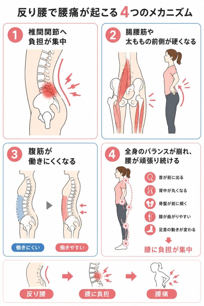 反り腰が腰痛を引き起こす4つのメカニズムを示したイラスト