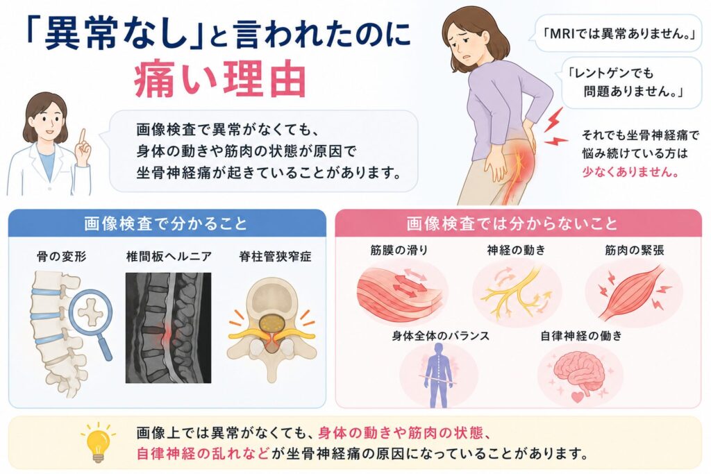 画像検査で異常なしでも坐骨神経痛が続く理由を説明したイラスト