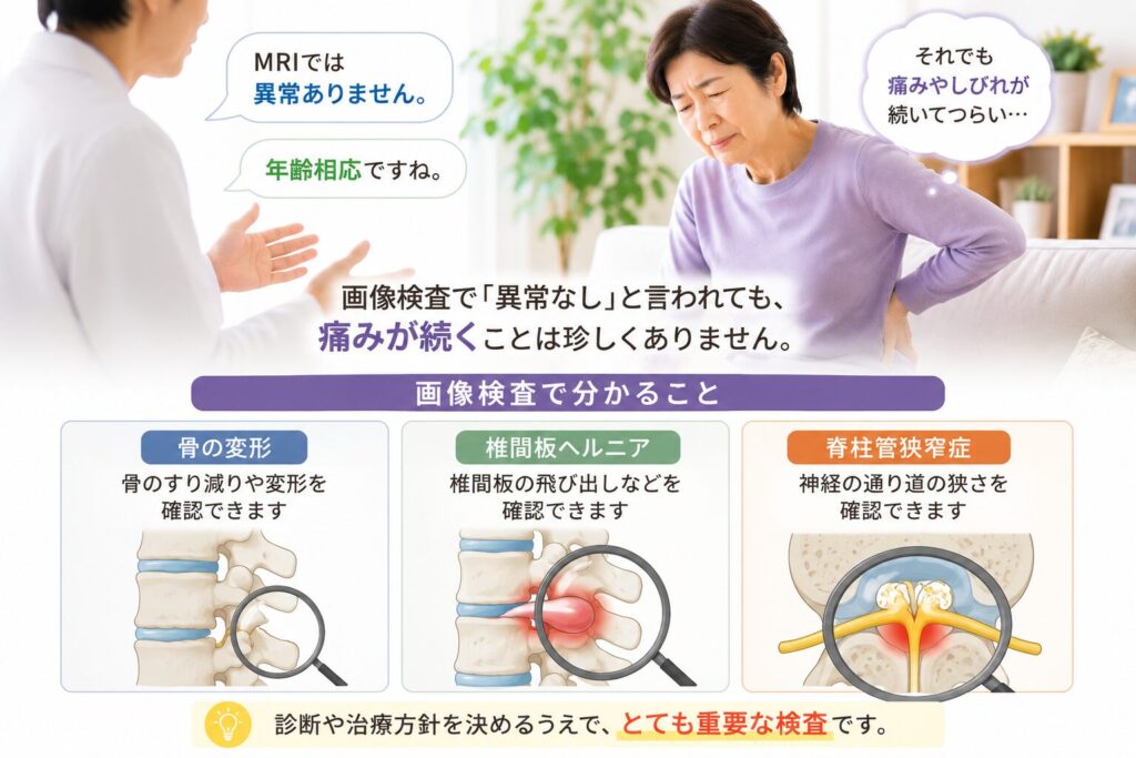 画像検査で異常なしでも痛みが続く理由を説明したイラスト